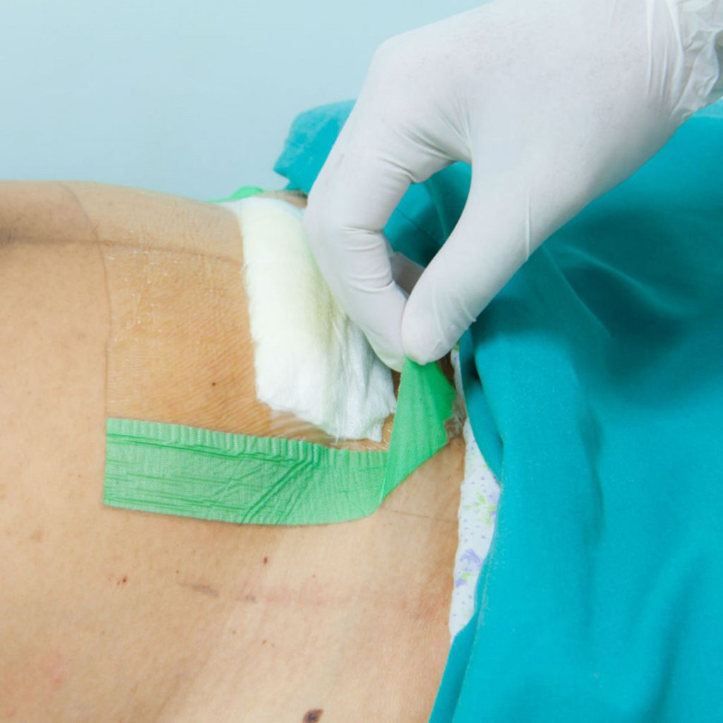 Ce qu’il faut savoir de l’après césarienne mutuelle prévoyance santé